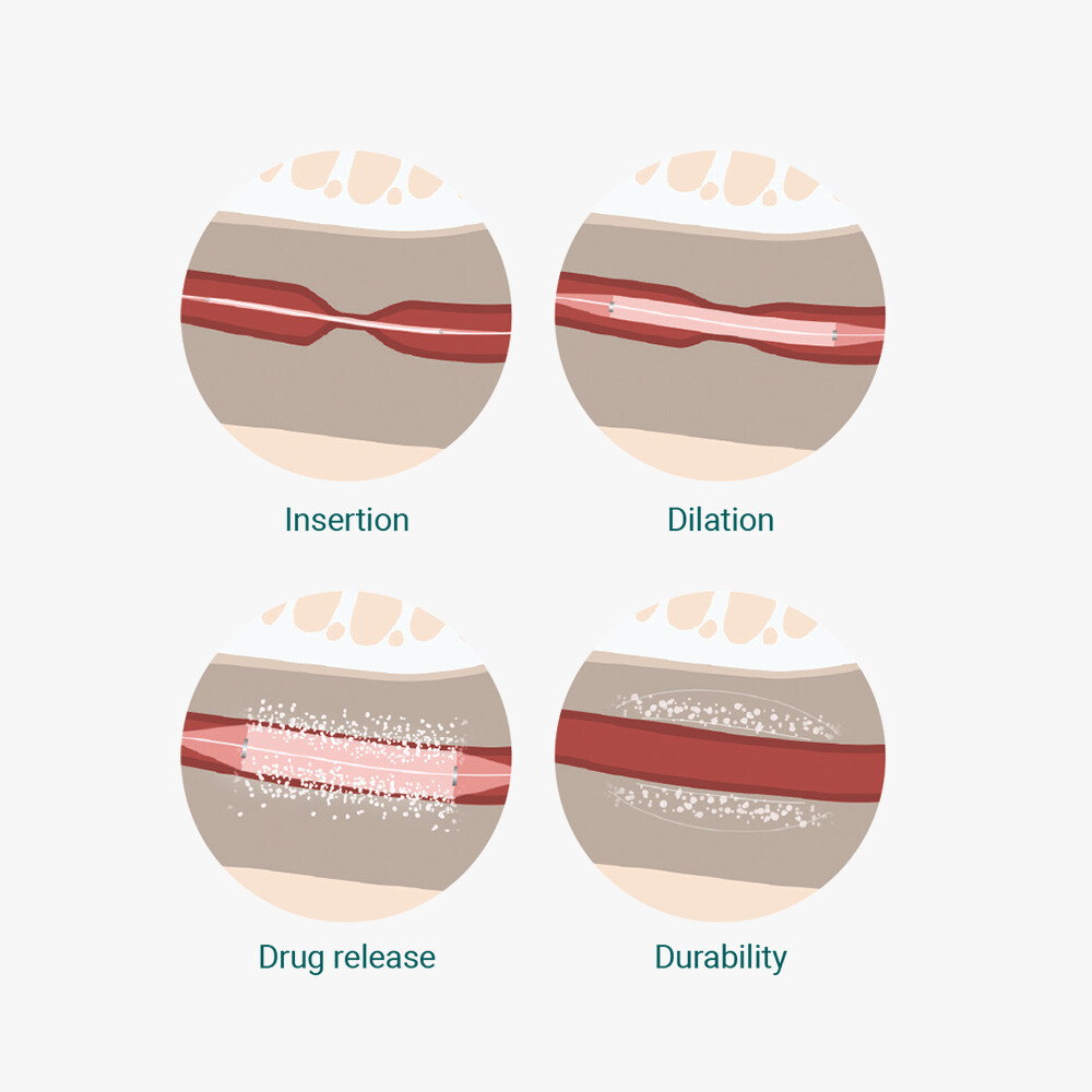 Minimalinvasive Operation mit Optilume® bei Harnröhrenstriktur – Urologe Dr. Alan, Mannheim